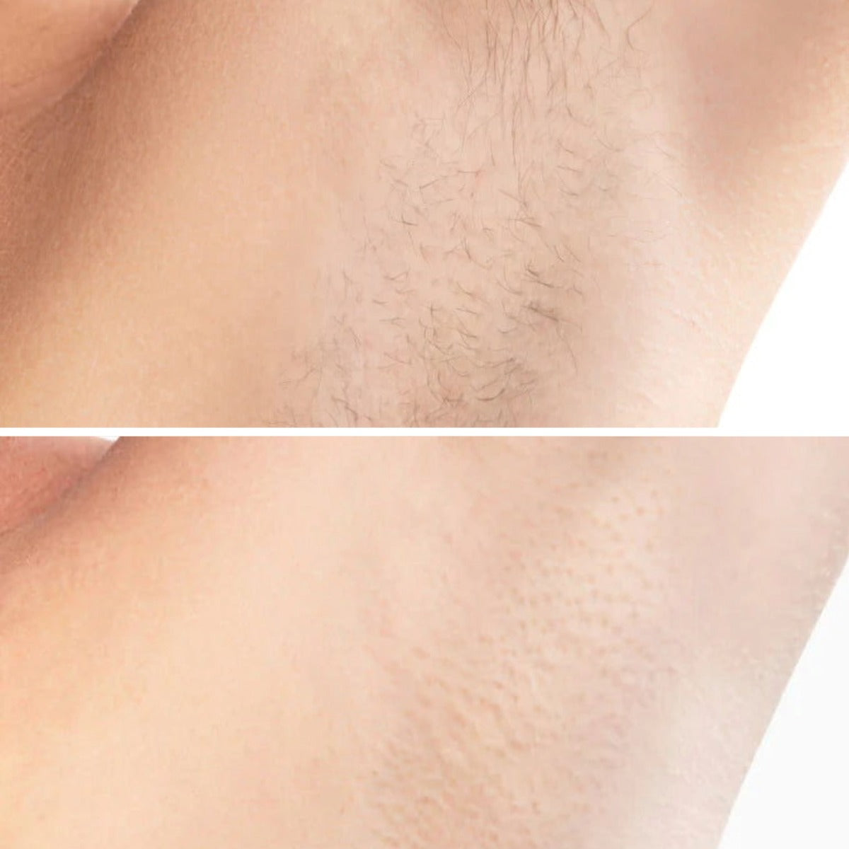 Auryn | Hair Removal Device — IPL Intense Pulsed Light Technology for At Home Use 3