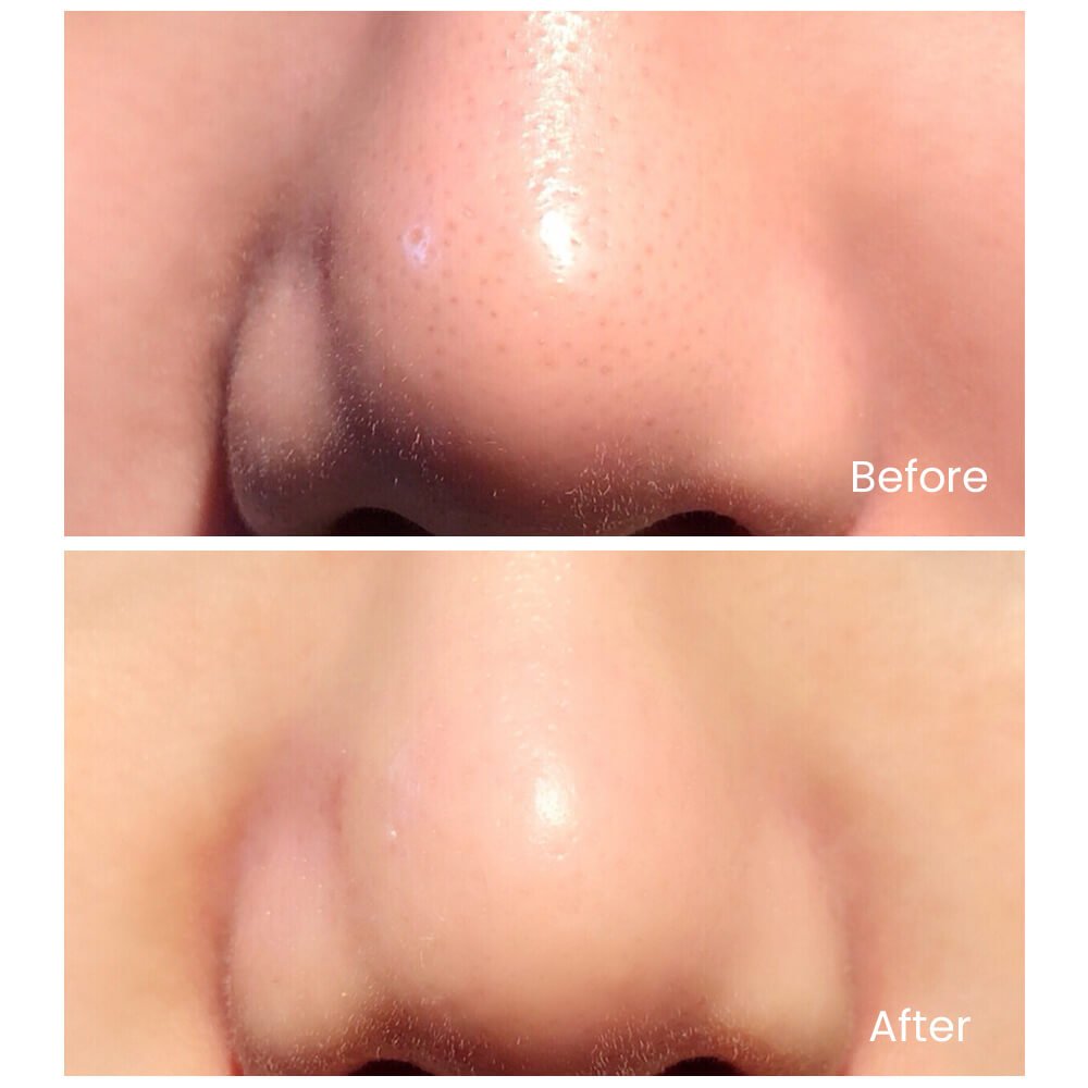 Lumex | Ultrasonic Scrub Device — Skin Cleansing Technology 3