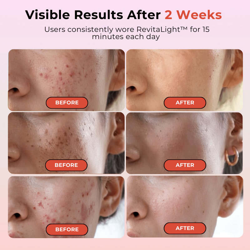 Luminara | LED Face Mask — Rechargeable Full Coverage Red Light Technology 3