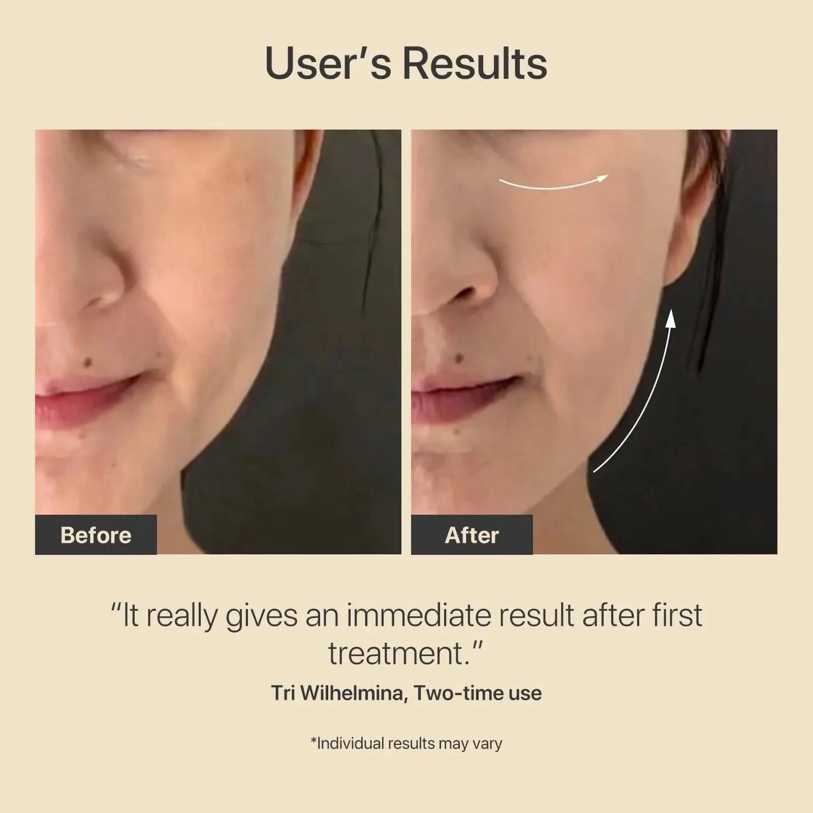 Lunara | Face Sculpting Tool — Advanced RF Rechargeable Facial Massage Device 4