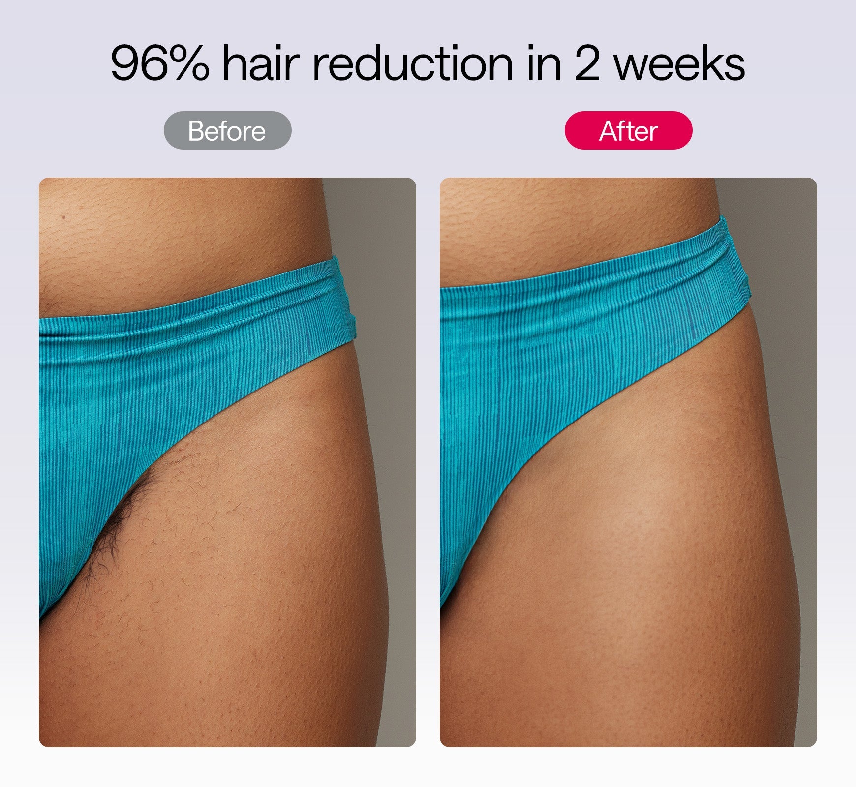 Lunara | Hair Removal Device — At Home Laser Technology for Smooth Skin 7
