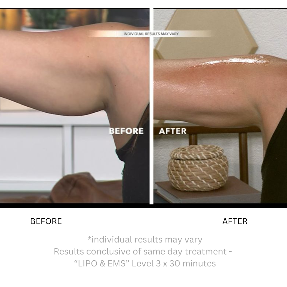 Solara | Body Sculpting Machine — EMS Vacuum Technology with Compact Design 7