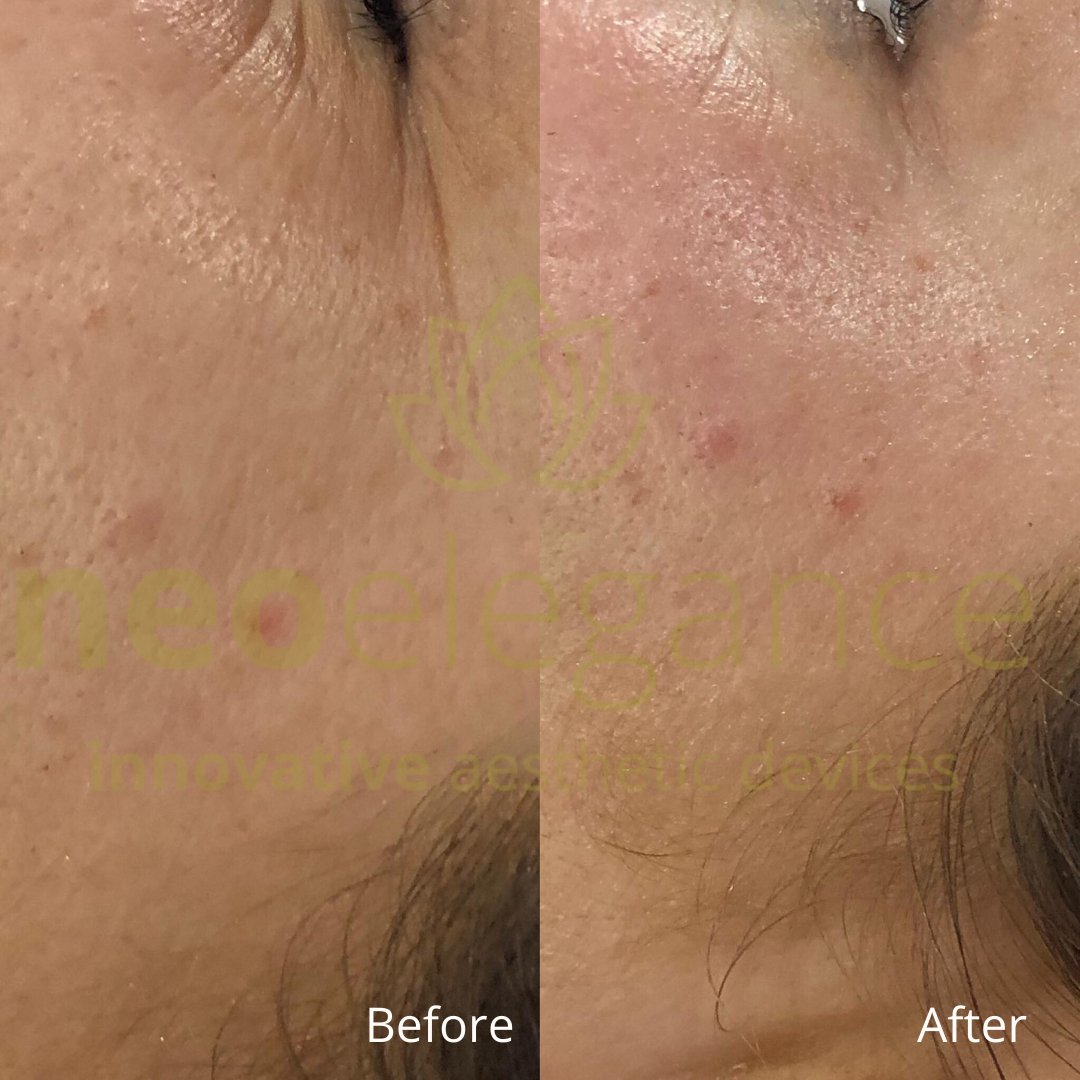 Velari | Facial Toning Device — Multi-Technology LED Sonic Massage System 6