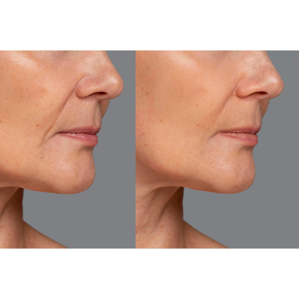 Zephira | LED Face Mask — Rechargeable Multi-Mode Skin Treatment Device 2