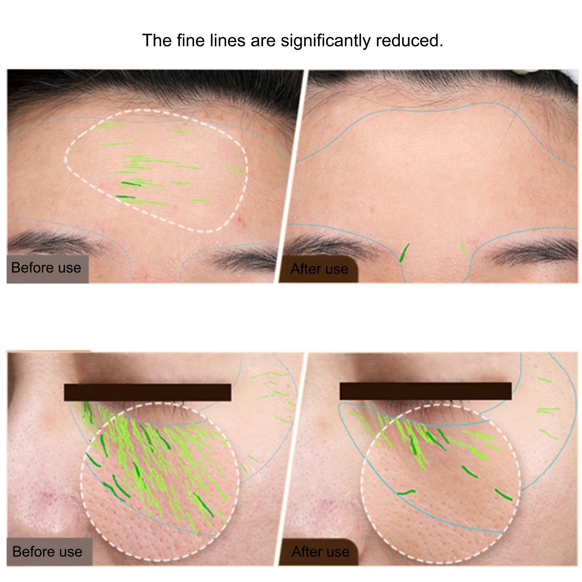 Zephira | RF Radio Frequency Machine — Compact Dual Mode Facial & Body Device 2