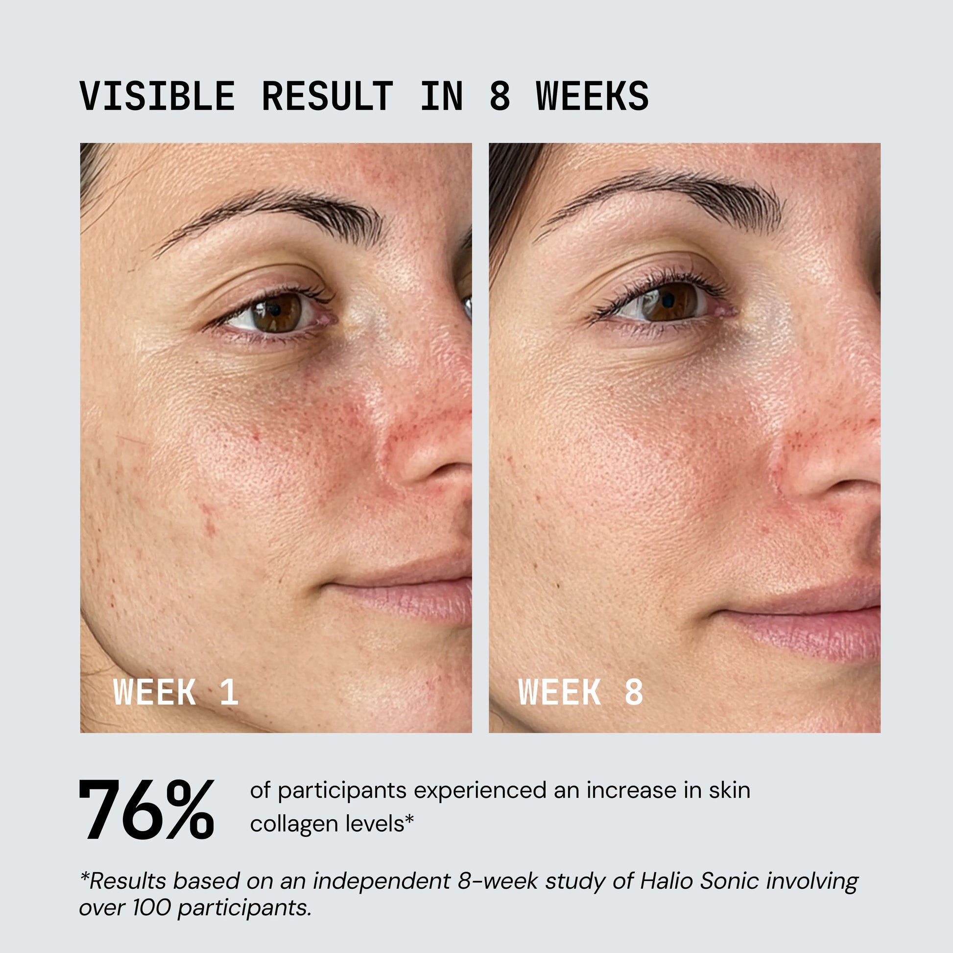 Zephira | Skin Rejuvenator Device — RF and EMS Technology with Multiple Light Options 6